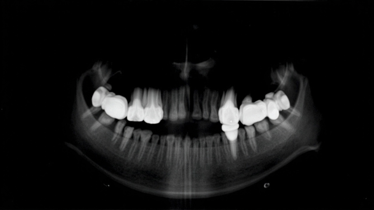 Illustration showing types of wisdom tooth impaction: mesial, distal, horizontal, and vertical impaction relative to the second molar